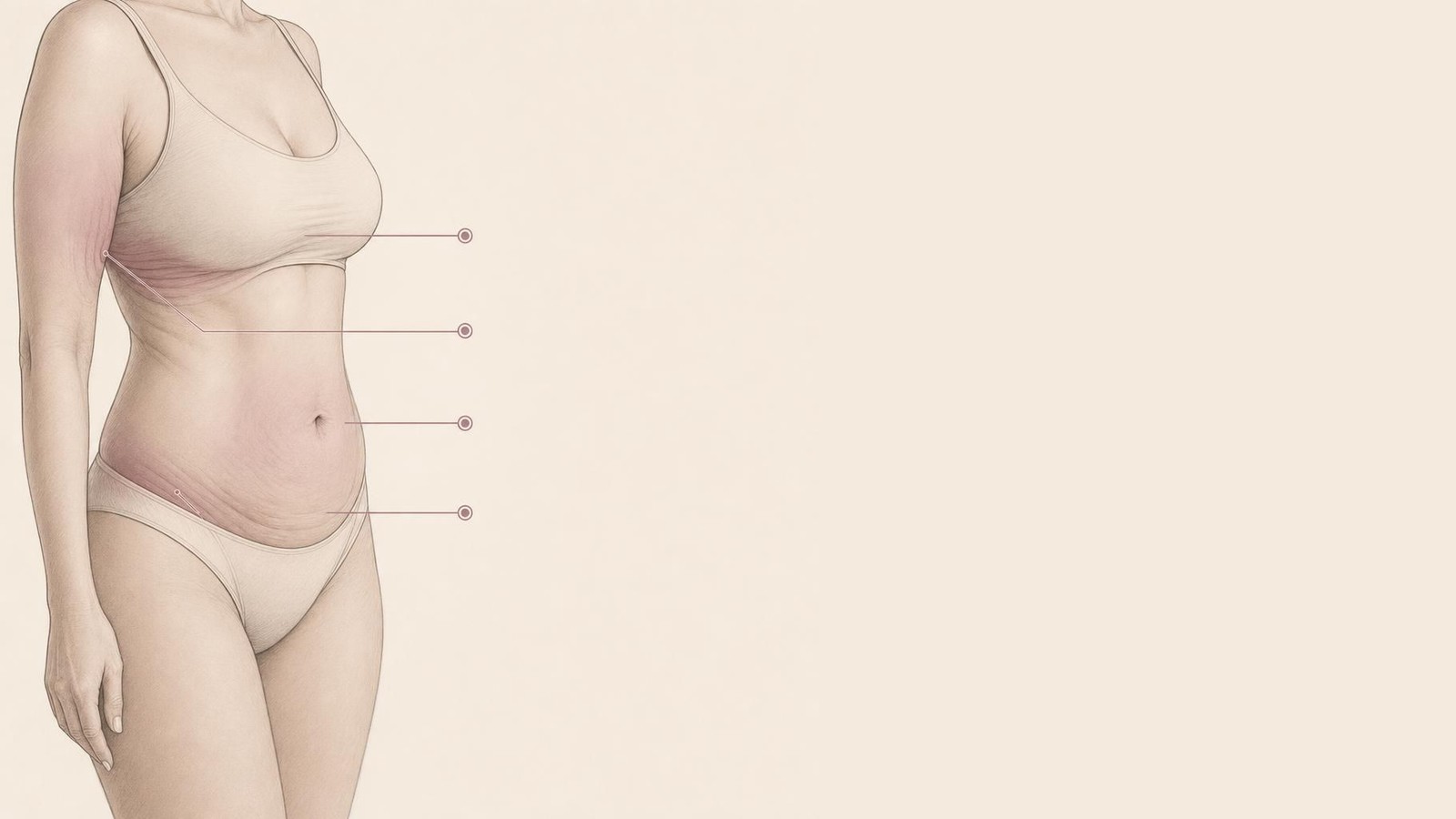 Illustration showing common areas of loose skin and contour change after significant weight loss, including the arms, breasts, and abdomen